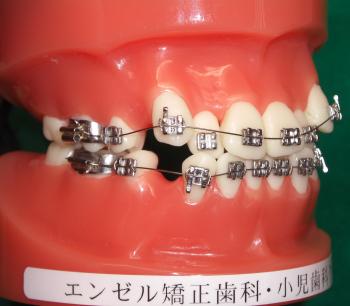 抜歯治療のモデル（模型）