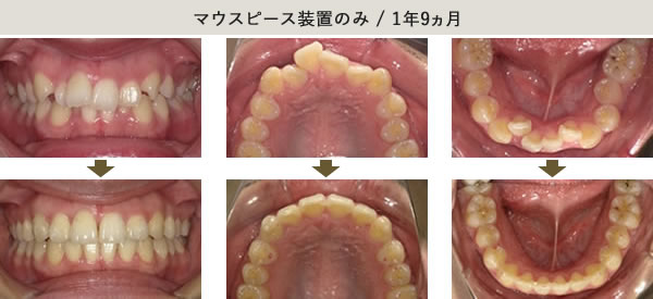 マウスピース装置のみ・1年9カ月