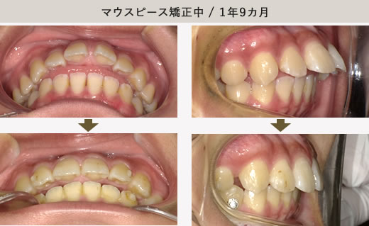 マウスピース装置のみ・1年9カ月