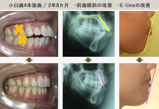 マウスピース装置のみ・1年9カ月