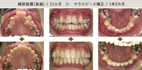 補助装置(抜歯)/11カ月 マウスピース矯正/1年2カ月