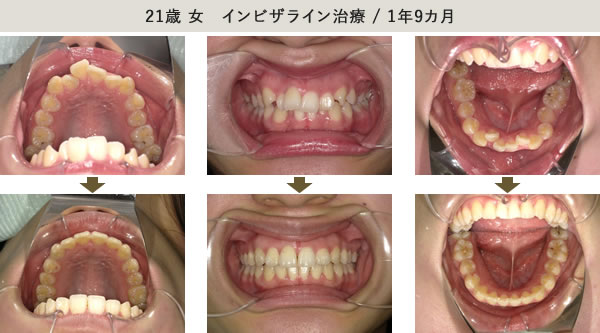 マウスピース装置のみ・1年9カ月