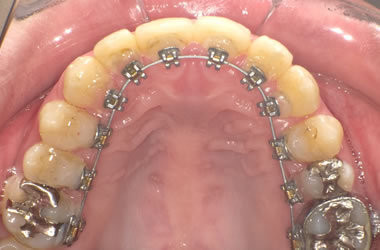 リンガル矯正（裏側）